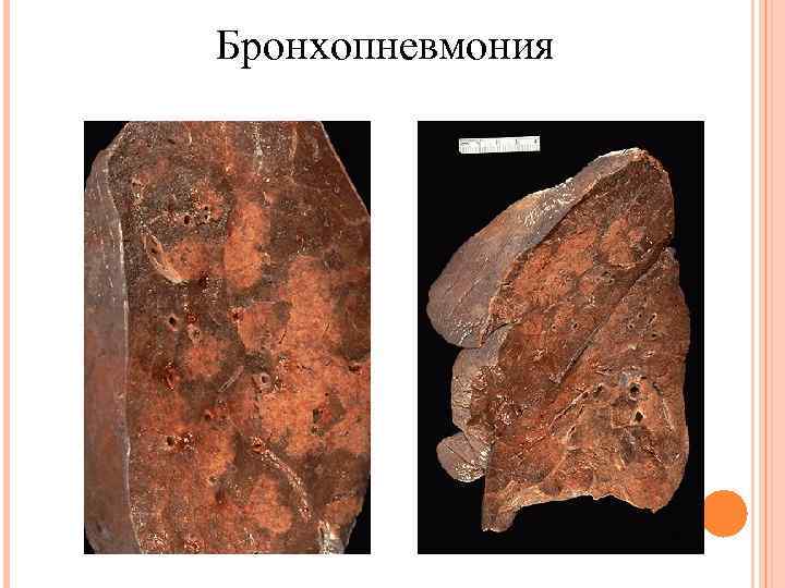 Бронхопневмония 