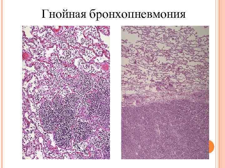 Гнойная бронхопневмония 