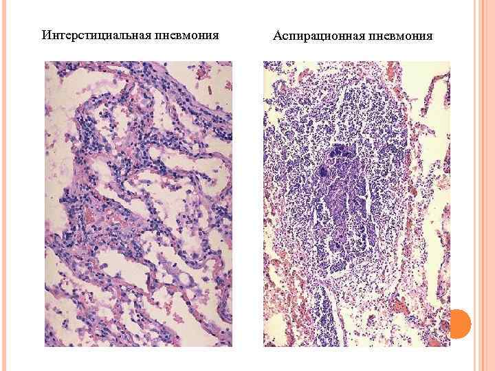 Интерстициальная пневмония Аспирационная пневмония 