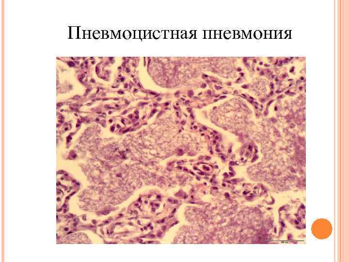 Пневмоцистная пневмония 