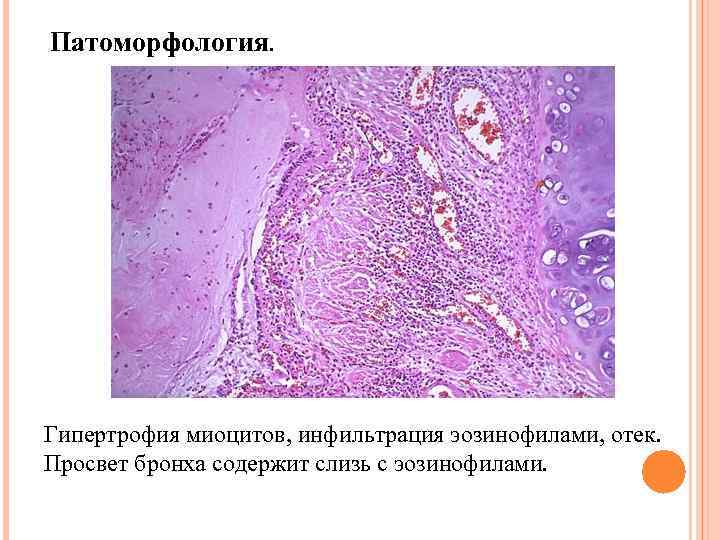Патоморфология. Гипертрофия миоцитов, инфильтрация эозинофилами, отек. Просвет бронха содержит слизь с эозинофилами. 