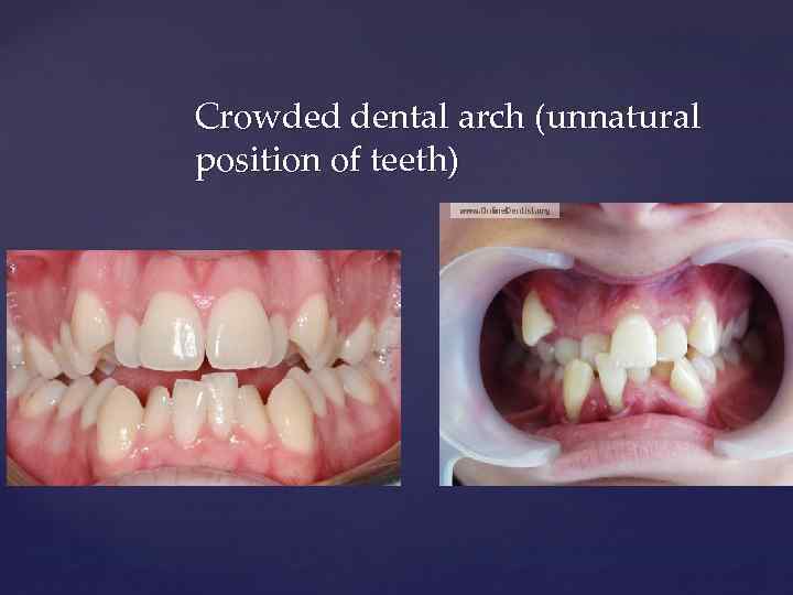 Crowded dental arch (unnatural position of teeth) 