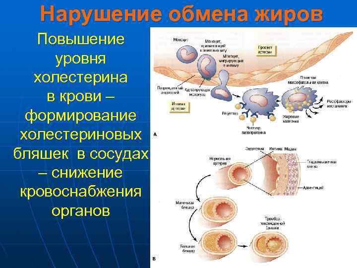 Нарушение обмена жиров Повышение уровня холестерина в крови – формирование холестериновых бляшек в сосудах