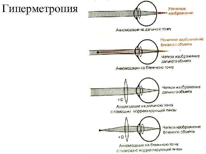 Что такое гиперметропия слабой степени