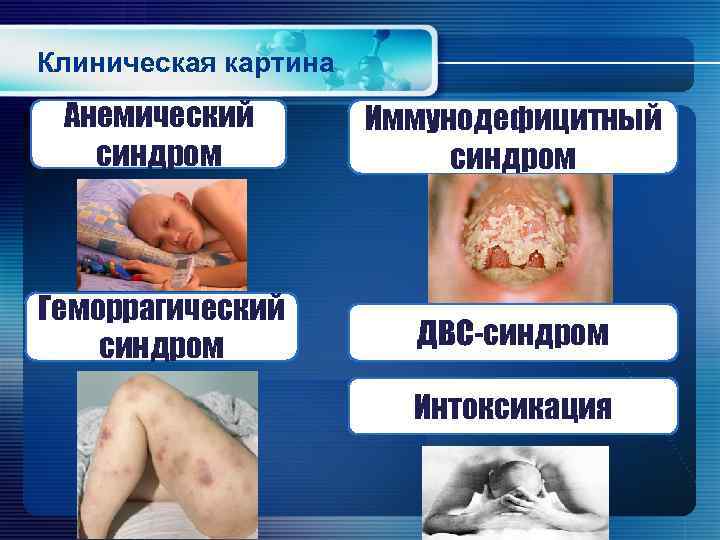 Клиническая картина Анемический синдром Иммунодефицитный синдром Геморрагический синдром ДВС-синдром Интоксикация 
