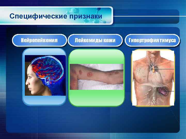 Специфические признаки Нейролейкемия Лейкемиды кожи Гипертрофия тимуса 