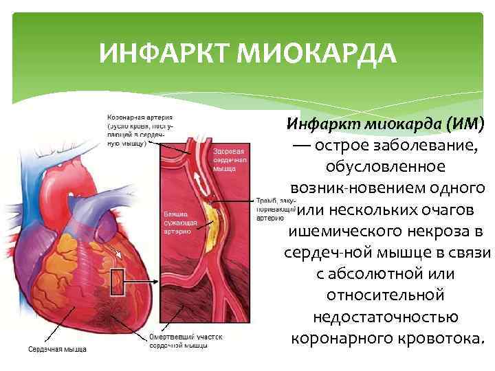 ИНФАРКТ МИОКАРДА Инфаркт миокарда (ИМ) — острое заболевание, обусловленное возник новением одного или нескольких