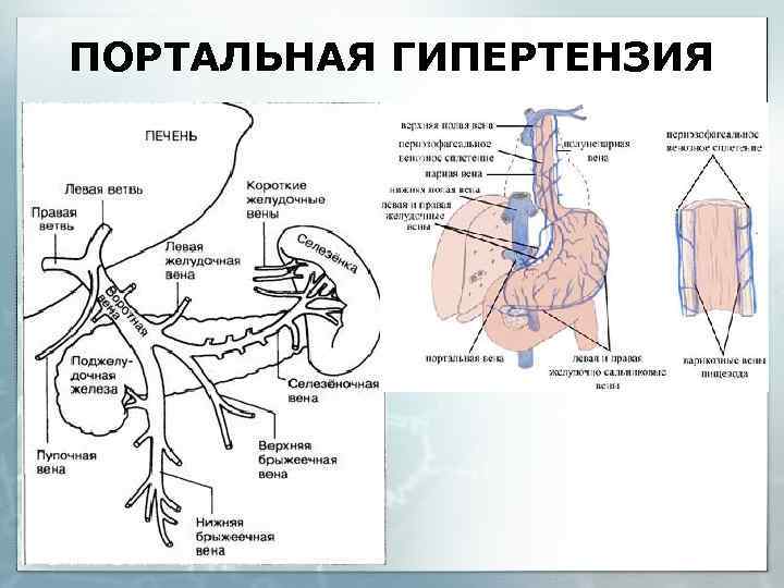 ПОРТАЛЬНАЯ ГИПЕРТЕНЗИЯ 