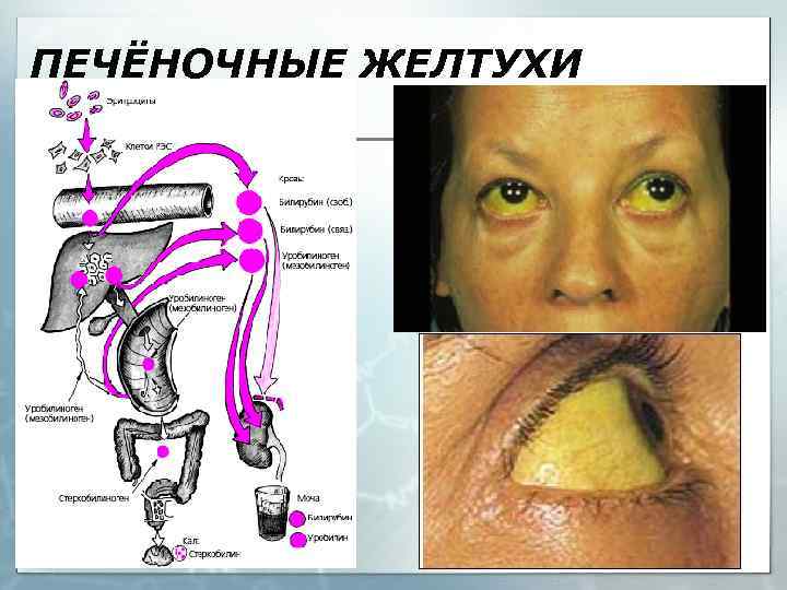 ПЕЧЁНОЧНЫЕ ЖЕЛТУХИ 