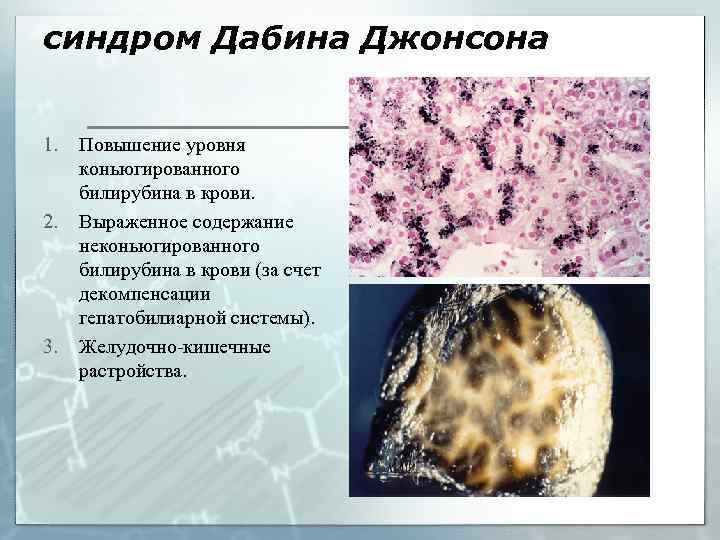 синдром Дабина Джонсона 1. 2. 3. Повышение уровня коньюгированного билирубина в крови. Выраженное содержание