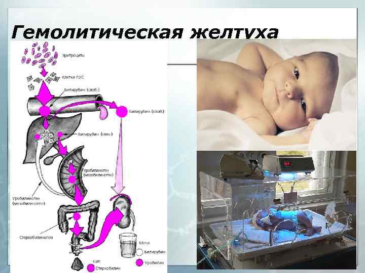 Гемолитическая желтуха 