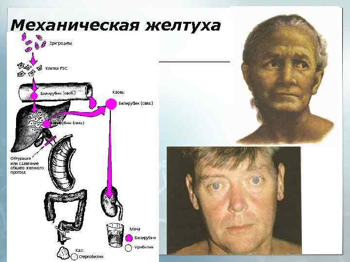 Механическая желтуха 