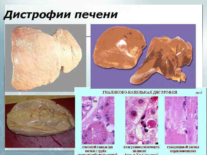 Дистрофии печени 