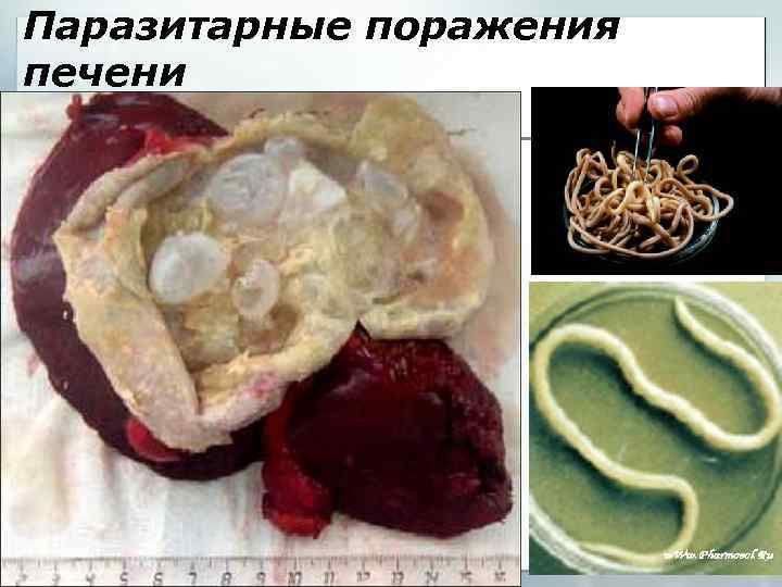 Паразитарные поражения печени 