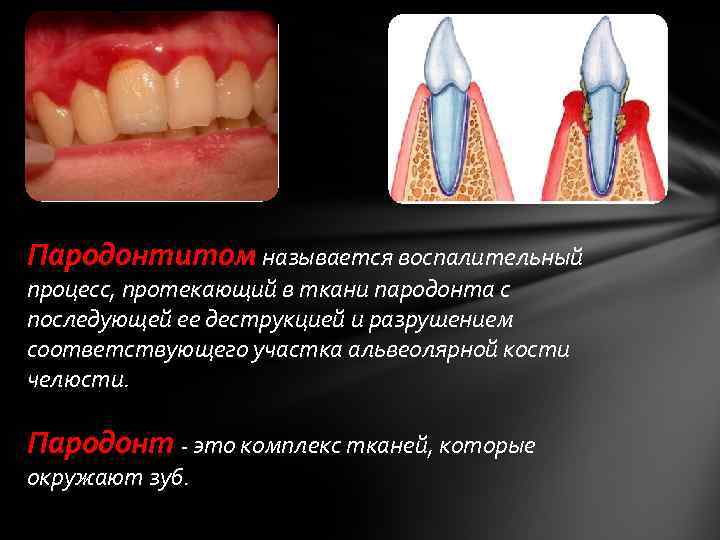 Пародонтитом называется воспалительный процесс, протекающий в ткани пародонта с последующей ее деструкцией и разрушением