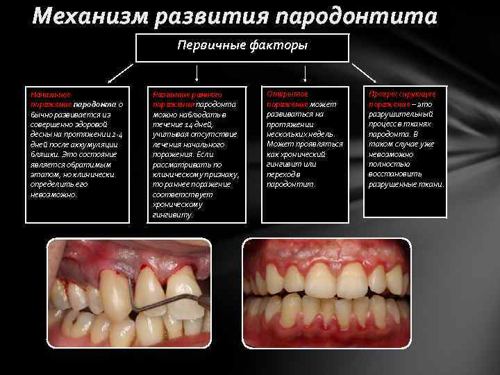 Механизм развития пародонтита Первичные факторы Начальное поражение пародонта о бычно развивается из совершенно здоровой