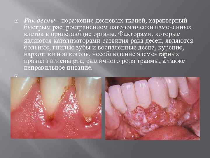  Рак десны - поражение десневых тканей, характерный быстрым распространением патологически измененных клеток в