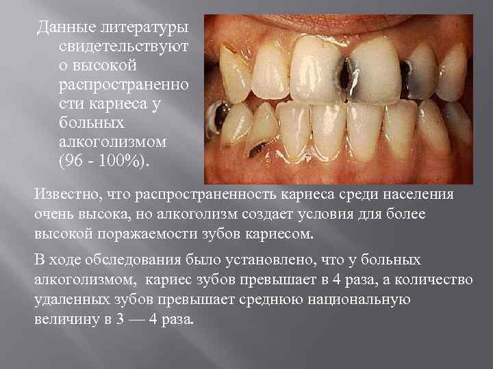 Данные литературы свидетельствуют о высокой распространенно сти кариеса у больных алкоголизмом (96 - 100%).