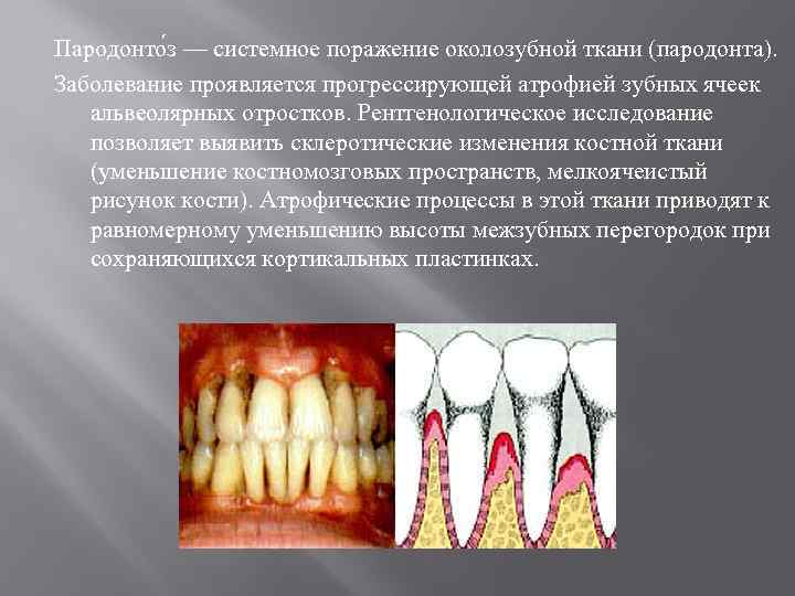 Пародонто з — системное поражение околозубной ткани (пародонта). Заболевание проявляется прогрессирующей атрофией зубных ячеек