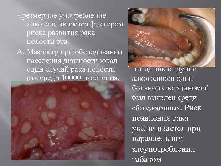 Чрезмерное употребление алкоголя является фактором риска развития рака полости рта. A. Mashberg при обследовании