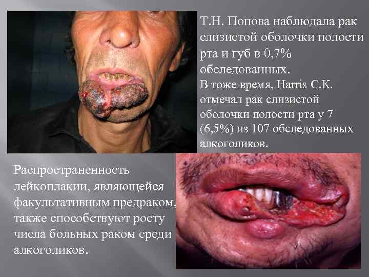 Т. H. Попова наблюдала рак слизистой оболочки полости рта и губ в 0, 7%