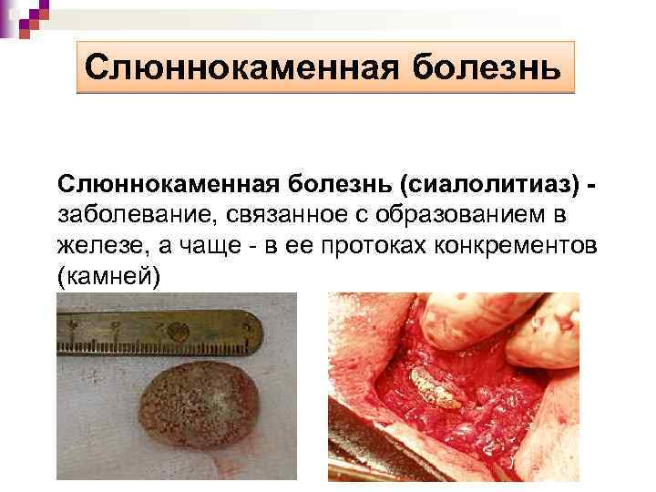 Слюннокаменная болезнь (сиалолитиаз) - заболевание, связанное с образованием в железе, а чаще - в