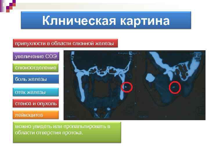 Клническая картина припухлости в области слюнной железы увеличение СОЭ слюноотделение боль железы отек железы