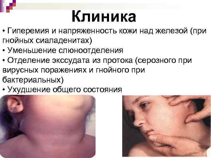 Клиника • Гиперемия и напряженность кожи над железой (при гнойных сиаладенитах) • Уменьшение слюноотделения