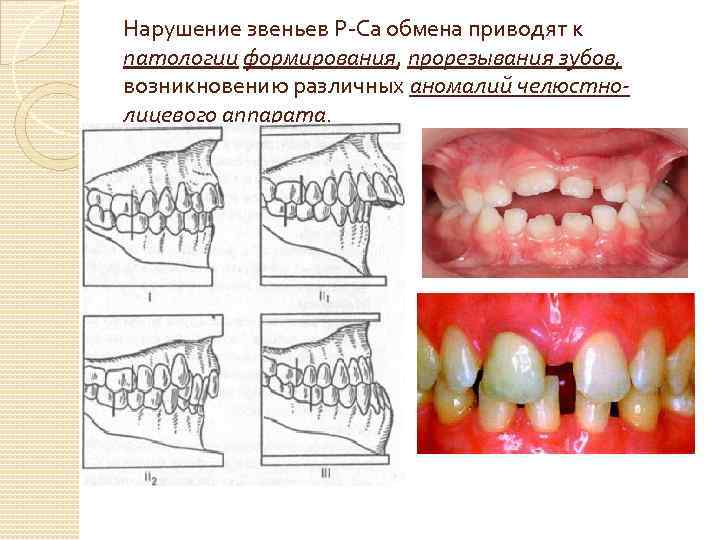 Нарушение звеньев Р-Са обмена приводят к патологии формирования, прорезывания зубов, возникновению различных аномалий челюстнолицевого