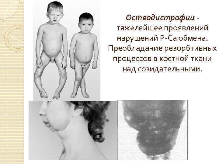 Остеодистрофии тяжелейшее проявлений нарушений Р-Са обмена. Преобладание резорбтивных процессов в костной ткани над созидательными.