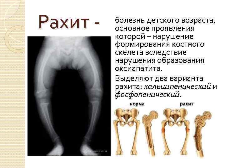 Рахит презентация казакша