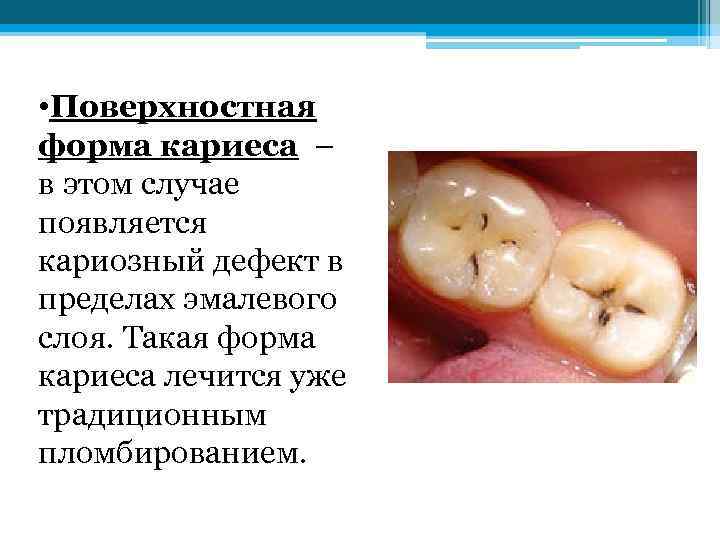  • Поверхностная форма кариеса – в этом случае появляется кариозный дефект в пределах