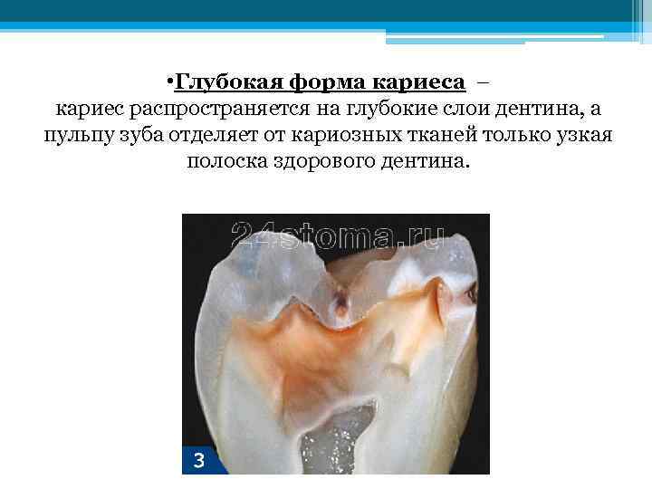  • Глубокая форма кариеса – кариес распространяется на глубокие слои дентина, а пульпу