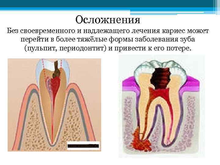 Осложнения Без своевременного и надлежащего лечения кариес может перейти в более тяжёлые формы заболевания