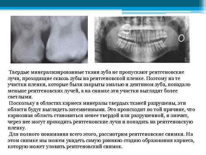  Твердые минерализированные ткани зуба не пропускают рентгеновские лучи, проходящие сквозь зубы на рентгеновской