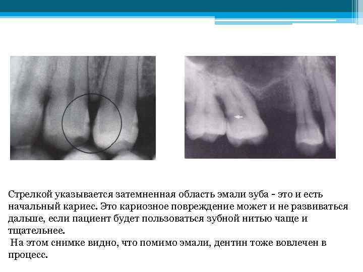 Стрелкой указывается затемненная область эмали зуба - это и есть начальный кариес. Это кариозное