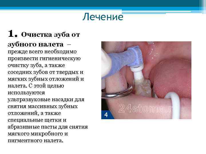 Лечение 1. Очистка зуба от зубного налета – прежде всего необходимо произвести гигиеническую очистку