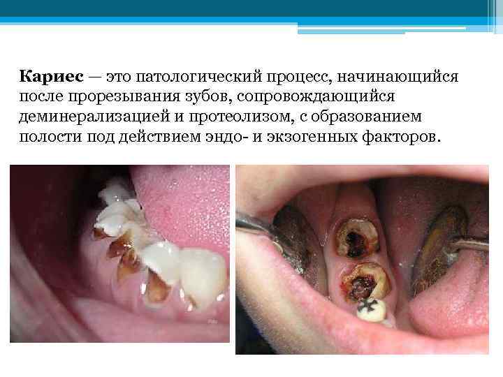 Кариес — это патологический процесс, начинающийся после прорезывания зубов, сопровождающийся деминерализацией и протеолизом, с