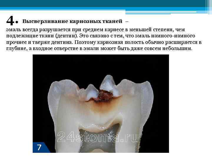 4. Высверливание кариозных тканей – эмаль всегда разрушается при среднем кариесе в меньшей степени,