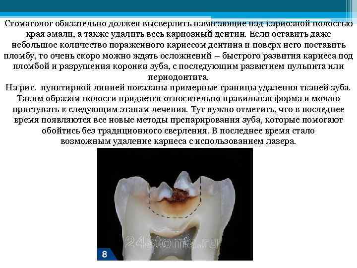 Стоматолог обязательно должен высверлить нависающие над кариозной полостью края эмали, а также удалить весь