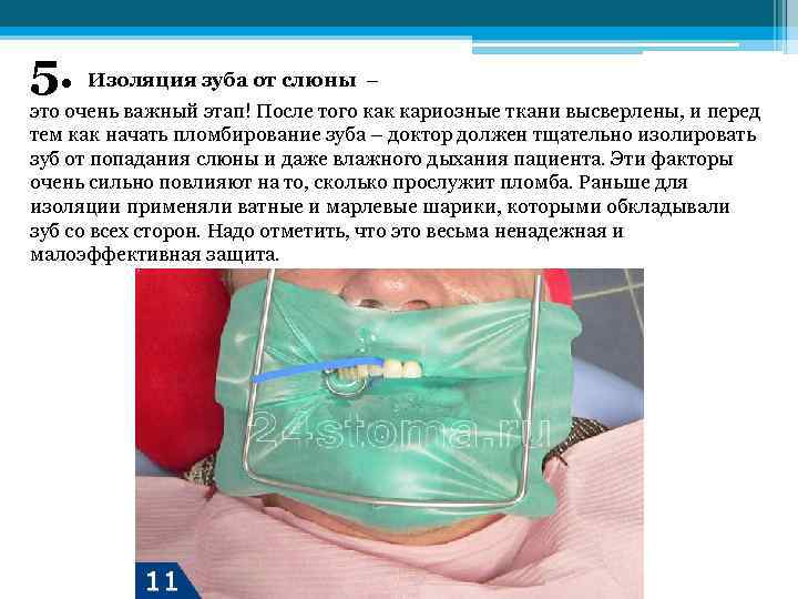 5. Изоляция зуба от слюны – это очень важный этап! После того как кариозные