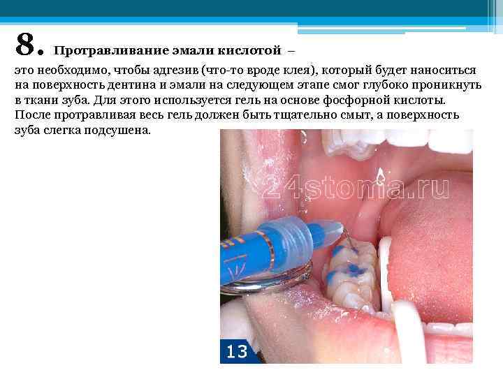 8. Протравливание эмали кислотой – это необходимо, чтобы адгезив (что-то вроде клея), который будет