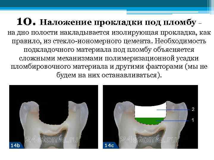 Патофизиология кариеса презентация