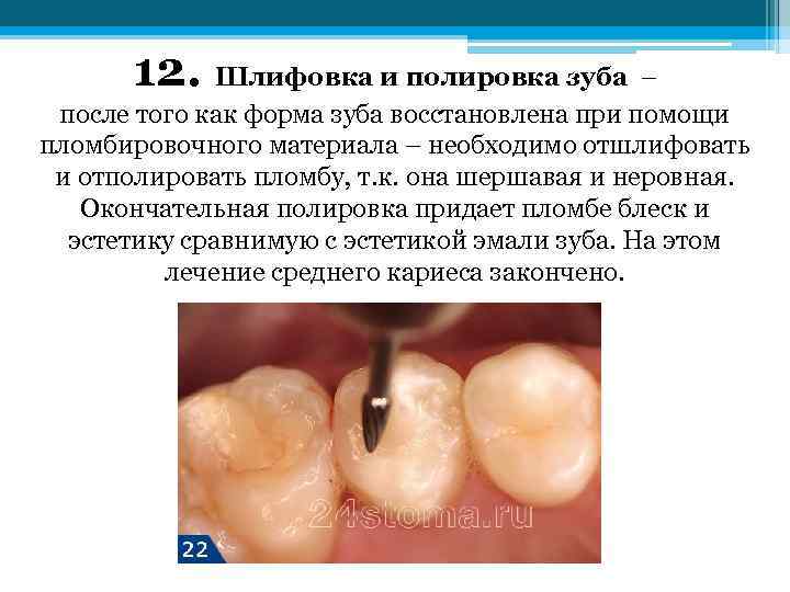 12. Шлифовка и полировка зуба – после того как форма зуба восстановлена при помощи
