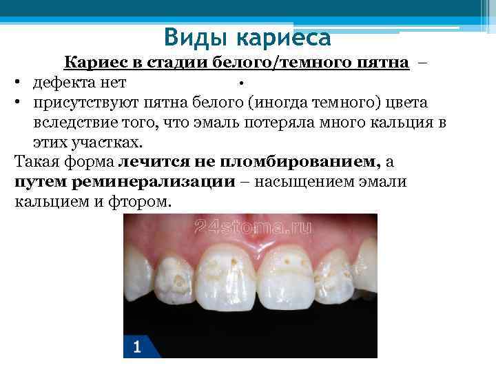 Виды кариеса Кариес в стадии белого/темного пятна – • • дефекта нет • присутствуют