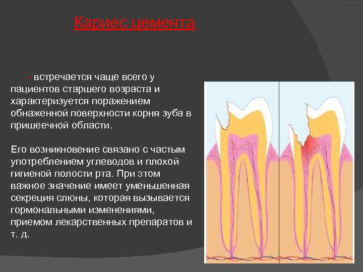 Кариес клиническая картина