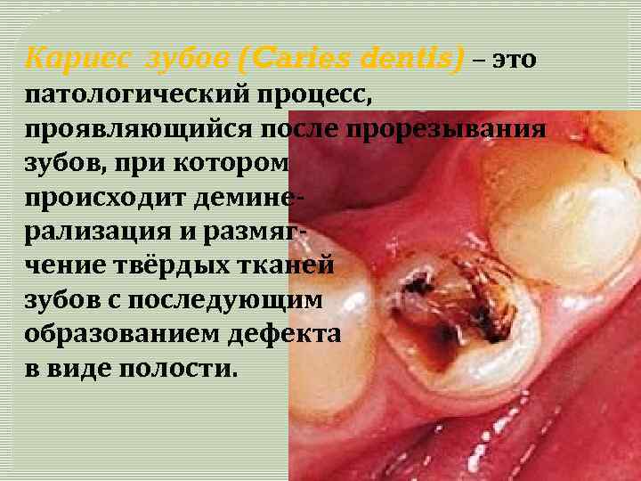 Кариес зубов (Caries dentis) – это патологический процесс, проявляющийся после прорезывания зубов, при котором