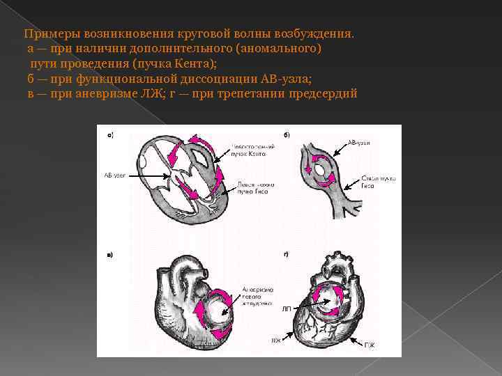 Примеры возникновения круговой волны возбуждения. а — при наличии дополнительного (аномального) пути проведения (пучка