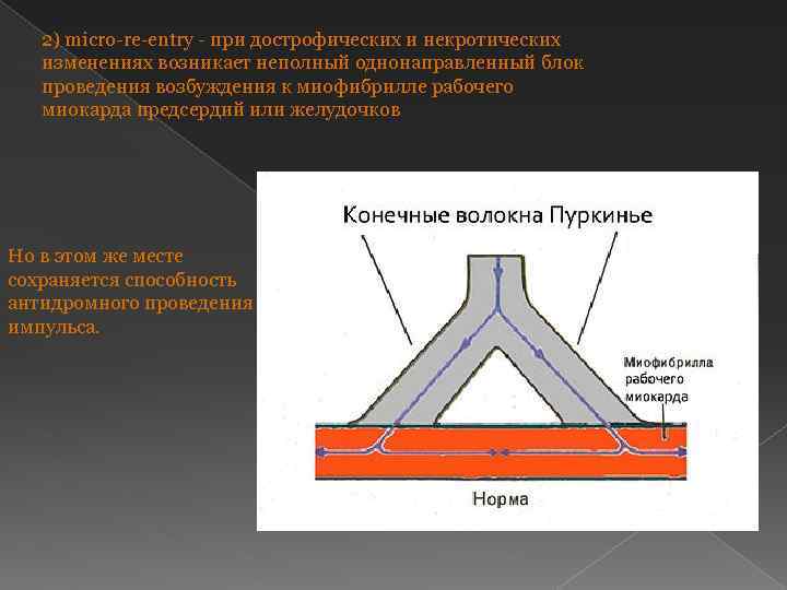 2) micro-re-entry - при дострофических и некротических изменениях возникает неполный однонаправленный блок проведения возбуждения