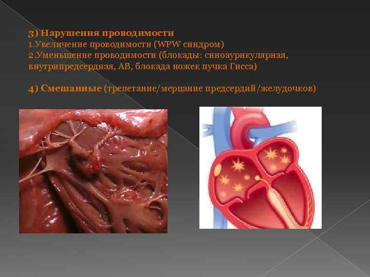 3) Нарушения проводимости 1. Увеличение проводимости (WPW синдром) 2. Уменьшение проводимости (блокады: синоаурикулярная, внутрипредсердная,